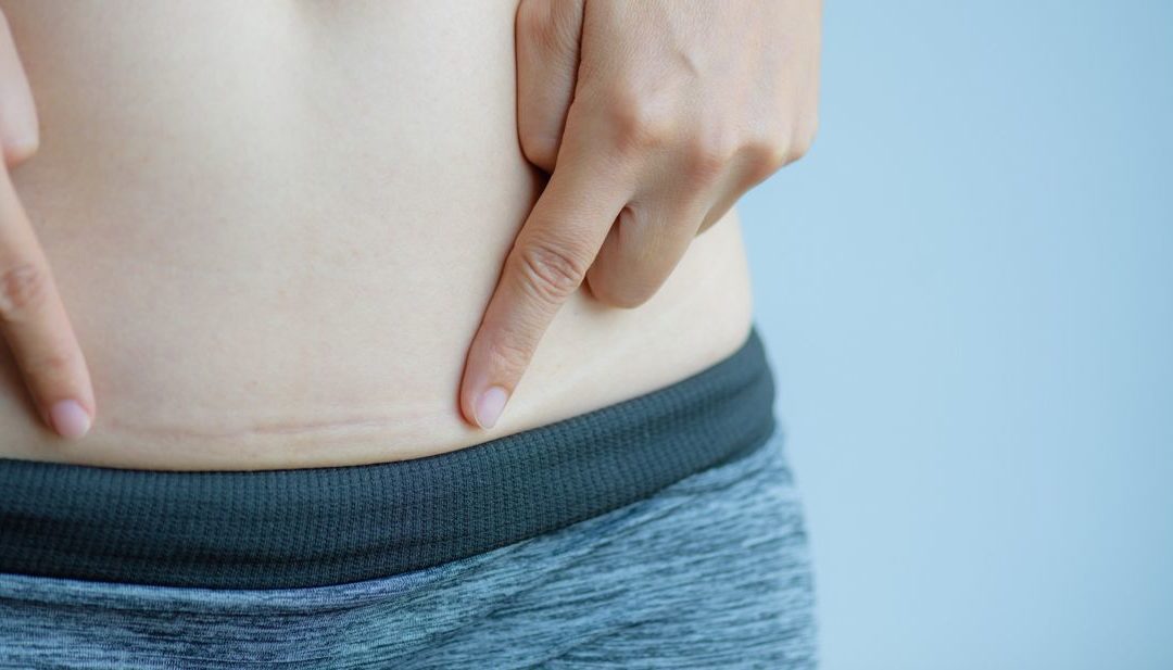 How to Recover After a Caesarean-section? Part 2: D21-D90